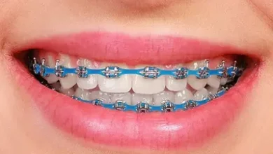 power chain braces